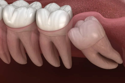 Removal of Wisdom Teeth 